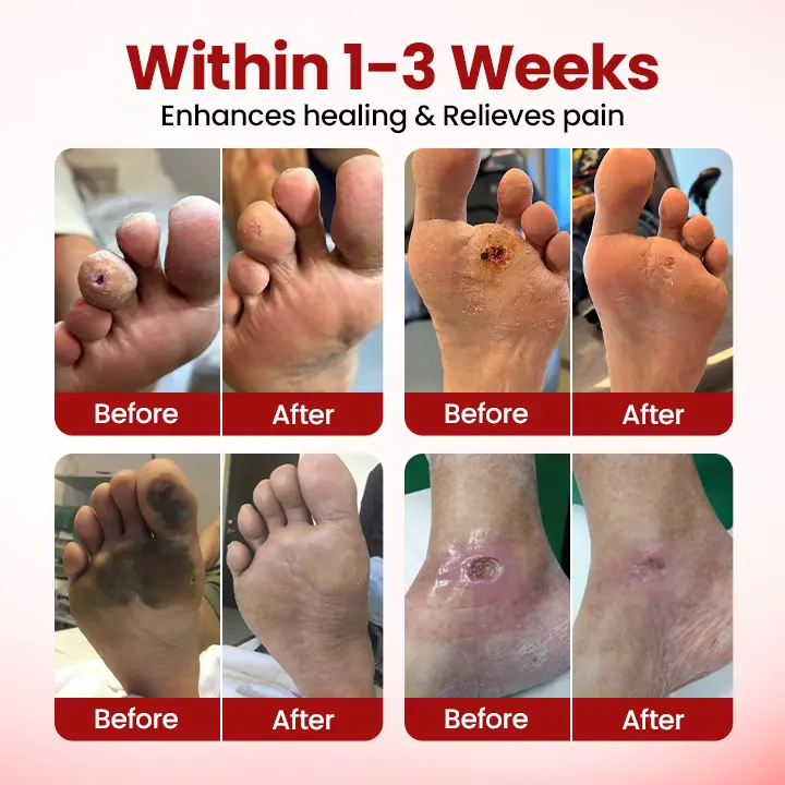 🔥Extra 40% Off 2nd Item!✨️Healrize® FootGuard Diabetic Care Cream