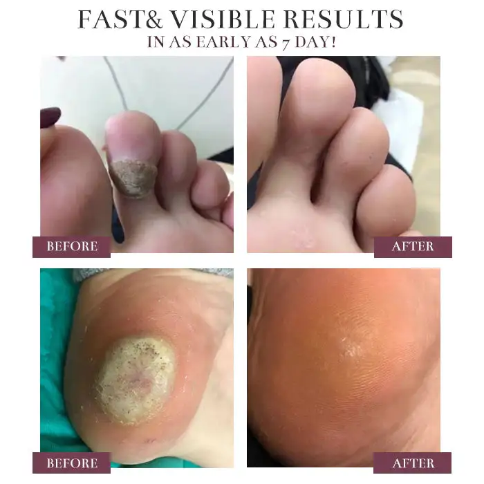 Healrize® BlackRice Nano Clear Wart Repair Cream