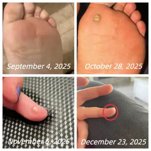 Healrize® Bee Venom Spray Joint Relief Wart Treatment, Two Effects in One Bottle