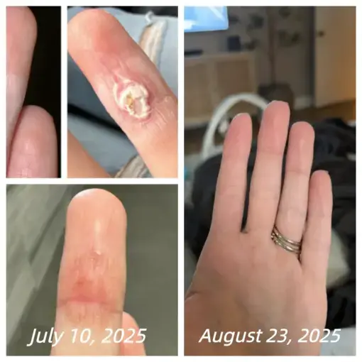 Healrize® Bee Venom Spray Joint Relief Wart Treatment, Two Effects in One Bottle