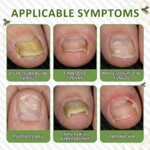 Healrize® NailRescue Bee Venom Spray