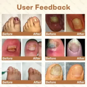 Healrize® NailRescue BeeVenom Renewal Spray