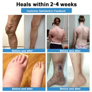 Healrize® 🛒4-in-1 Vein & Joint Nano Microneedle Advanced Therapy Patch🔥Instant Relief, Long-Term Results