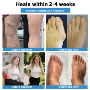 Healrize® 🛒4-in-1 Vein & Joint Nano Microneedle Advanced Therapy Patch🔥Instant Relief, Long-Term Results