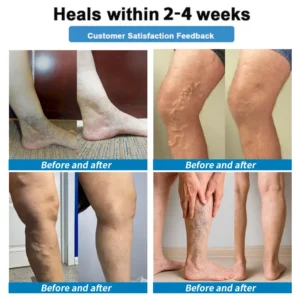 Healrize® 🛒4-in-1 Vein & Joint Nano Microneedle Advanced Therapy Patch🔥Instant Relief, Long-Term Results