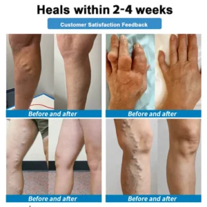 Healrize® 🛒4-in-1 Vein & Joint Nano Microneedle Advanced Therapy Patch🔥Instant Relief, Long-Term Results