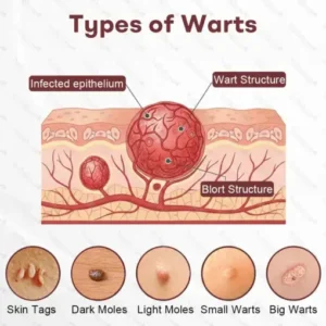 Healrize® BlackRice DermCorrect™ Wart Recovery Cream Suitable for all skin types