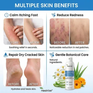 🔥Healrize® Magnesium Botanical Spray – Advanced Skin Recovery for Psoriasis & Eczema | Rapid Soothing, Steroid-Free