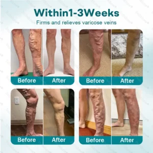 Healrize® Rapid Vein Relief Microdarts✅| 7-Day Visible & ALL SKIN TYPES