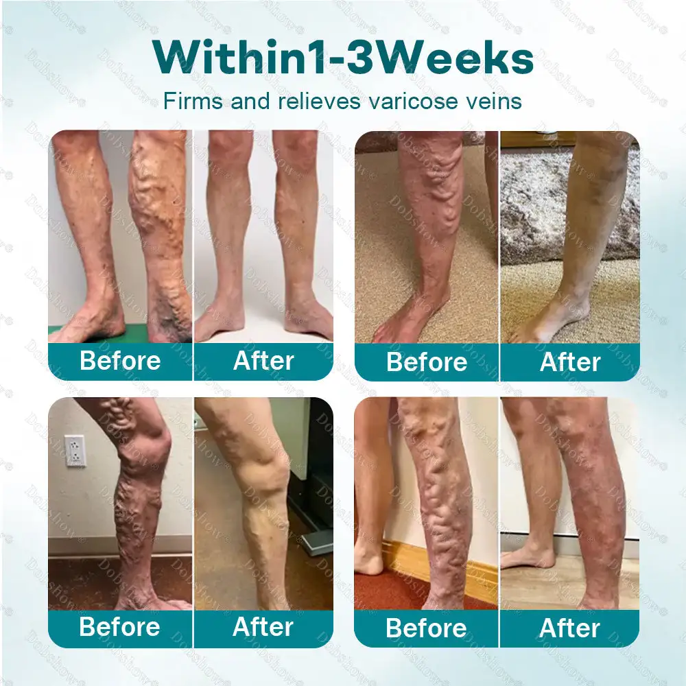 Healrize® Rapid Vein Relief Microdarts✅| 7-Day Visible & ALL SKIN TYPES