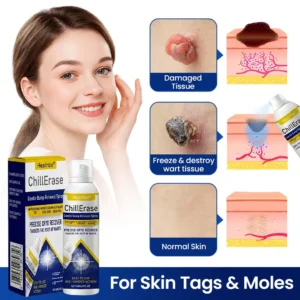 Healrize®ChillErase Gentle Bump Renewal Spray✨ — Pain-Free, Acid-Free Gentle Wart Removal