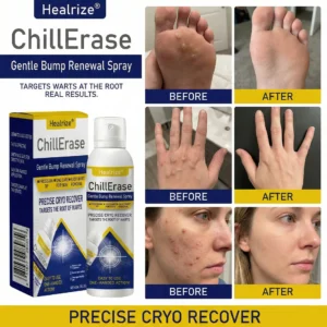 Healrize®ChillErase Gentle Bump Renewal Spray✨ — Pain-Free, Acid-Free Gentle Wart Removal