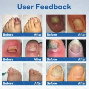 Healrize®Nano Rapid Clear Nail Fungus Rapair Liquid Effective in 7 Days, Permanently Eliminates the Root