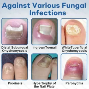 Healrize®Nano Rapid Clear Nail Fungus Rapair Liquid Effective in 7 Days, Permanently Eliminates the Root