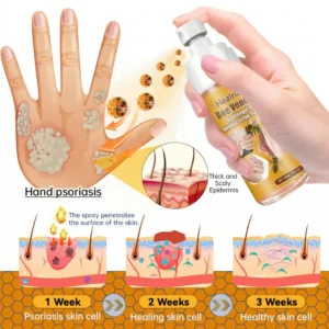🔥Best Seller🔥Healrize® Bee Venom Antifungal & Antibacterial Spray– Advanced Skin Recovery for Psoriasis & Eczema🎉Special Limited Time 50% OFF