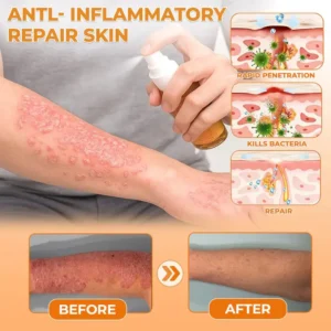 🔥Best Seller🔥Healrize® Bee Venom Antifungal & Antibacterial Spray🎉Special limited-time discount