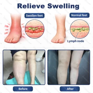 🔥Healrize® Advanced Edema Relief Cream | Herbal Soothing Ointment for Varicose Veins, Swelling & Leg Circulation🌿