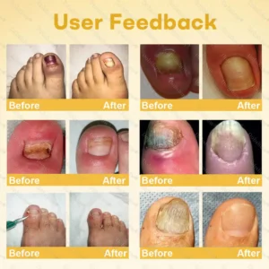 Healrize® Bee Venom Nail Rescue Spray