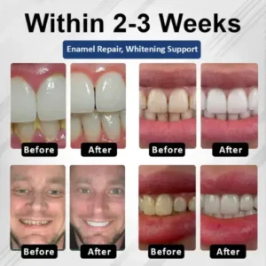 Healrize® BioEnamel Biomimetic Tooth Armor