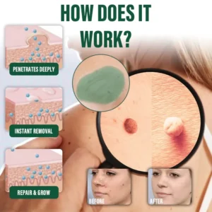 Healrize® DermaErase Instant Mole & Spot Remover Gel