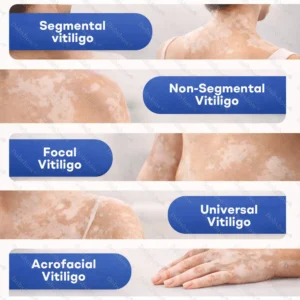 👨‍⚕️🔥Healrize® Piperine Vitiligo Repigmentation Spray - 🌿Steroid-Free Botanical Formula | Gentle & Effective for All Skin Types