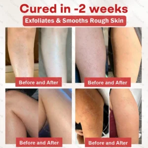 🎉Limited-time discount✨Healrize® Salicylic Acid Keratosis Spray | keratosis pilaris on arms & body