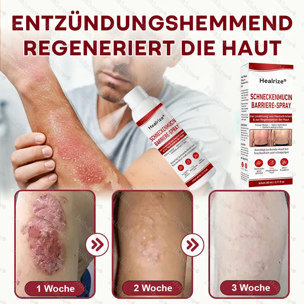 ๐Bestseller |๐Healrizeยฎ Schneckenmucin-Barriere-Spray zur Linderung von Hautschรผben und zur Regeneration der Haut-๐ฟ๐๐ช๐ฉ๐จ๐๐๐ก๐๐ฃ๐๐จ ๐๐ง. 1 ๐จ๐ฅ๐งรผ๐๐๐๐ง๐ ๐ฝ๐๐ง๐ง๐๐๐ง๐-๐๐๐ก๐๐๐ ๐๐๐ ๐๐จ๐ค๐ง๐๐๐จ๐๐จ