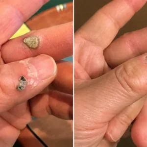 โ
๐บ๐ธ๐๐๐๐๐ฟ๐ถ๐ฏ๐ยฎ2-in-1 Microneedle & Hydrocolloid Patch๐| Removes Raised M
โ Cce Enchanted Store
