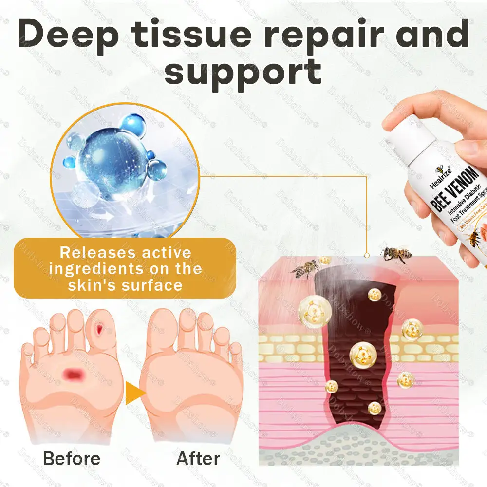 🎊Special limited-time discount-Healrize® Bee Venom Intensive Diabetic Foot Treatment Spray🔥Best Seller🔥