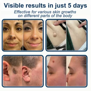 ✅🇺🇸𝐇𝐞𝒂𝒍𝗿𝗶𝙯𝙚®2-in-1 Microneedle & Hydrocolloid Patch🎀🎀| Removes Raised 
 – oxygenfe.com