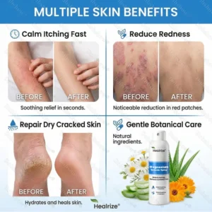 OFFICIAL
BRAND
Healrize® Magnesium Botanic Spray – Advanced Skin Recovery for Psoriasis & Eczema | Rapid Soothing, Steroid-Free