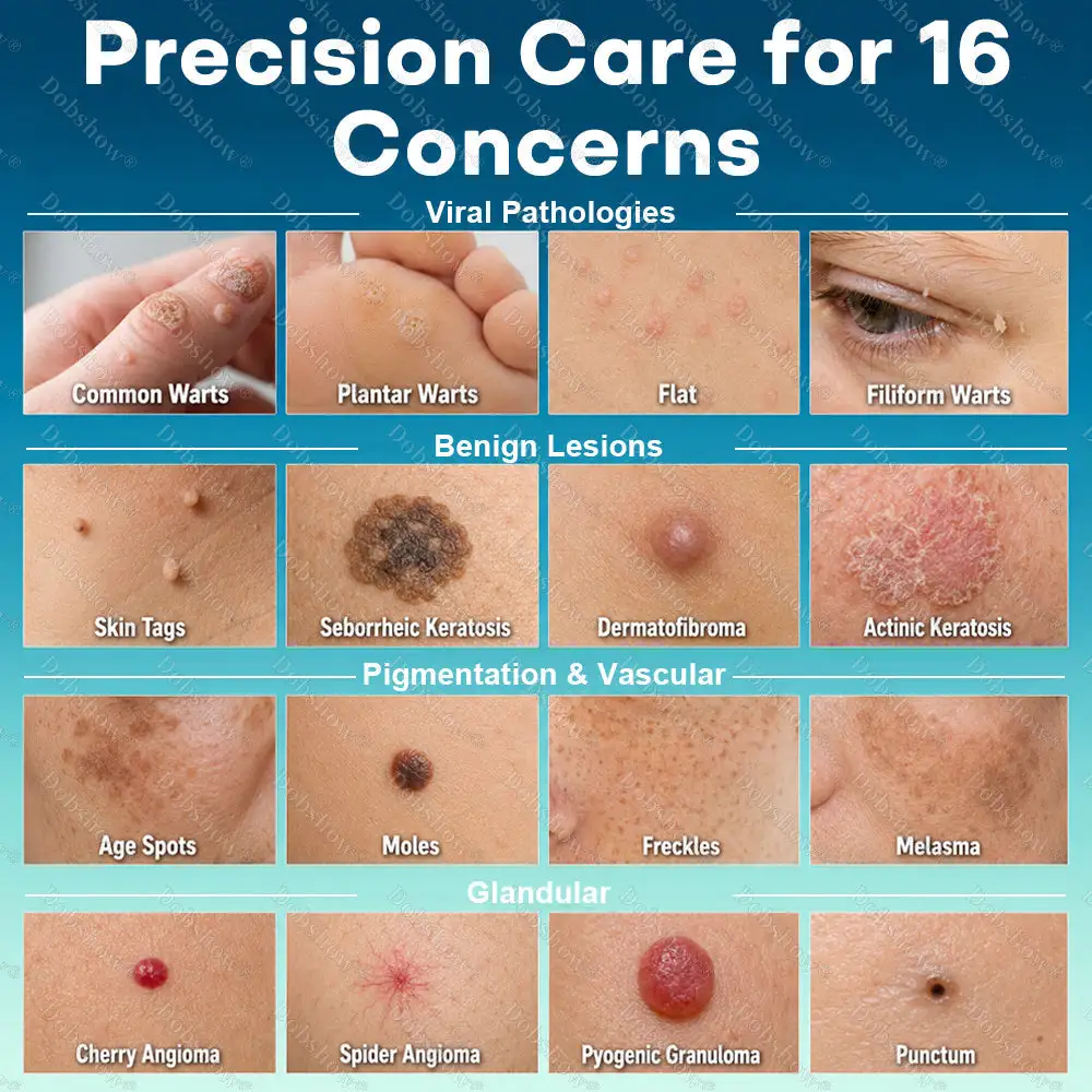 OFFICIAL
BRAND
Healrize® Precision Wart & Blemish Care Roll-On Pen