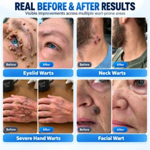 🎀🎀 𝐇𝐞𝐚𝐥𝐫𝐢𝐳𝐞® 𝐂𝐚𝐧𝐭𝐡𝐚𝐫𝐢𝐝𝐢𝐧™ 𝟕-𝐃𝐚𝐲 𝐀𝐝𝐯𝐚𝐧𝐜𝐞𝐝 𝐏𝐫𝐞𝐜𝐢𝐬𝐢𝐨𝐧 𝐁𝐫𝐮𝐬𝐡-𝐎𝐧 𝐖𝐚𝐫𝐭 𝐑𝐞𝐦𝐨𝐯𝐚𝐥 𝐒𝐨𝐥𝐮𝐭𝐢𝐨𝐧 ✅ (𝐓𝐚𝐫𝐠𝐞𝐭𝐞𝐝 𝐀𝐩𝐩𝐥𝐢𝐜𝐚𝐭𝐢𝐨𝐧, 𝐑𝐞𝐦𝐨𝐯𝐞 𝐀𝐥𝐥 𝐓𝐲𝐩𝐞𝐬 𝐨𝐟 𝐖𝐚𝐫𝐭𝐬 𝐖𝐢𝐭𝐡𝐢𝐧 𝟕 𝐃𝐚𝐲𝐬)