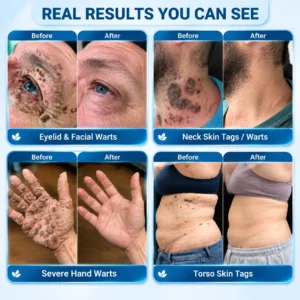 🎀🎀 𝐇𝐞𝐚𝐥𝐫𝐢𝐳𝐞® 𝐂𝐚𝐧𝐭𝐡𝐚𝐫𝐢𝐝𝐢𝐧™ 𝟕-𝐃𝐚𝐲 𝐀𝐝𝐯𝐚𝐧𝐜𝐞𝐝 𝐏𝐫𝐞𝐜𝐢𝐬𝐢𝐨𝐧 𝐁𝐫𝐮𝐬𝐡-𝐎𝐧 𝐖𝐚𝐫𝐭 𝐑𝐞𝐦𝐨𝐯𝐚𝐥 𝐒𝐨𝐥𝐮𝐭𝐢𝐨𝐧 ✅ (𝐓𝐚𝐫𝐠𝐞𝐭𝐞𝐝 𝐀𝐩𝐩𝐥𝐢𝐜𝐚𝐭𝐢𝐨𝐧, 𝐑𝐞𝐦𝐨𝐯𝐞 𝐀𝐥𝐥 𝐓𝐲𝐩𝐞𝐬 𝐨𝐟 𝐖𝐚𝐫𝐭𝐬 𝐖𝐢𝐭𝐡𝐢𝐧 𝟕 𝐃𝐚𝐲𝐬)